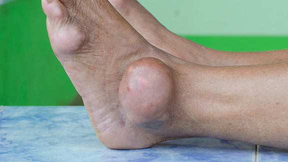 All About Gout; Symptoms, Diagnosis, Treatment