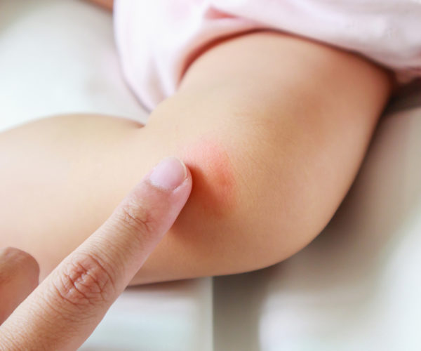 The ultimate guide to curing cellulitis