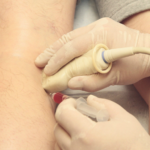 Stem Cell Therapy for Treating Knee Pain
