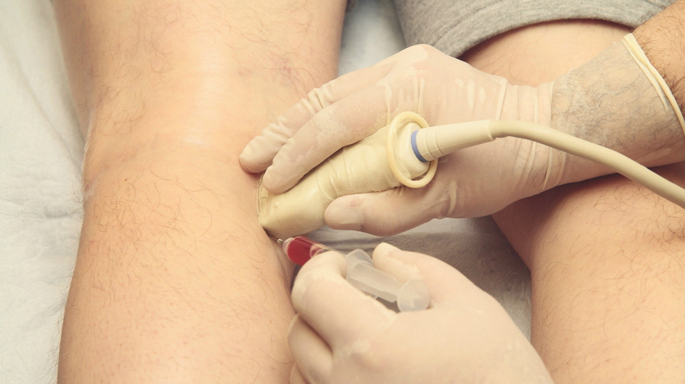Stem Cell Therapy for Treating Knee Pain
