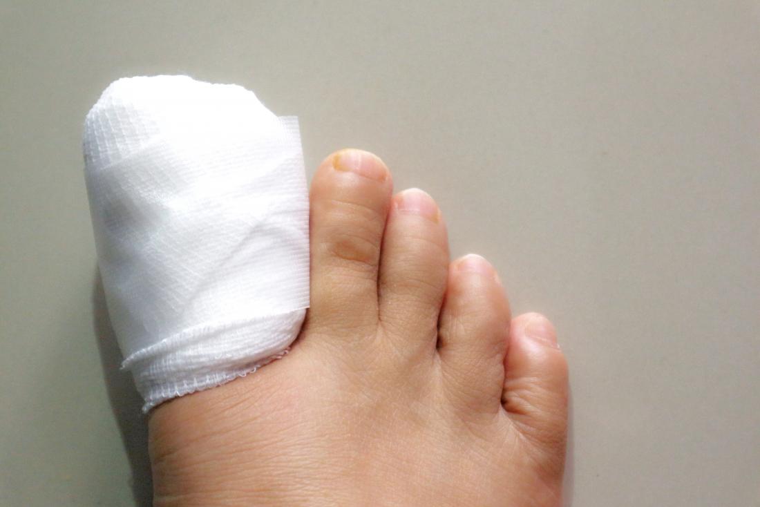 How Painful is Is Ingrown Toenail Surgery?