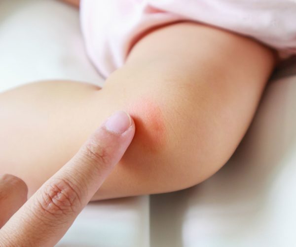 Child skin allergy treatment must be greatly considered