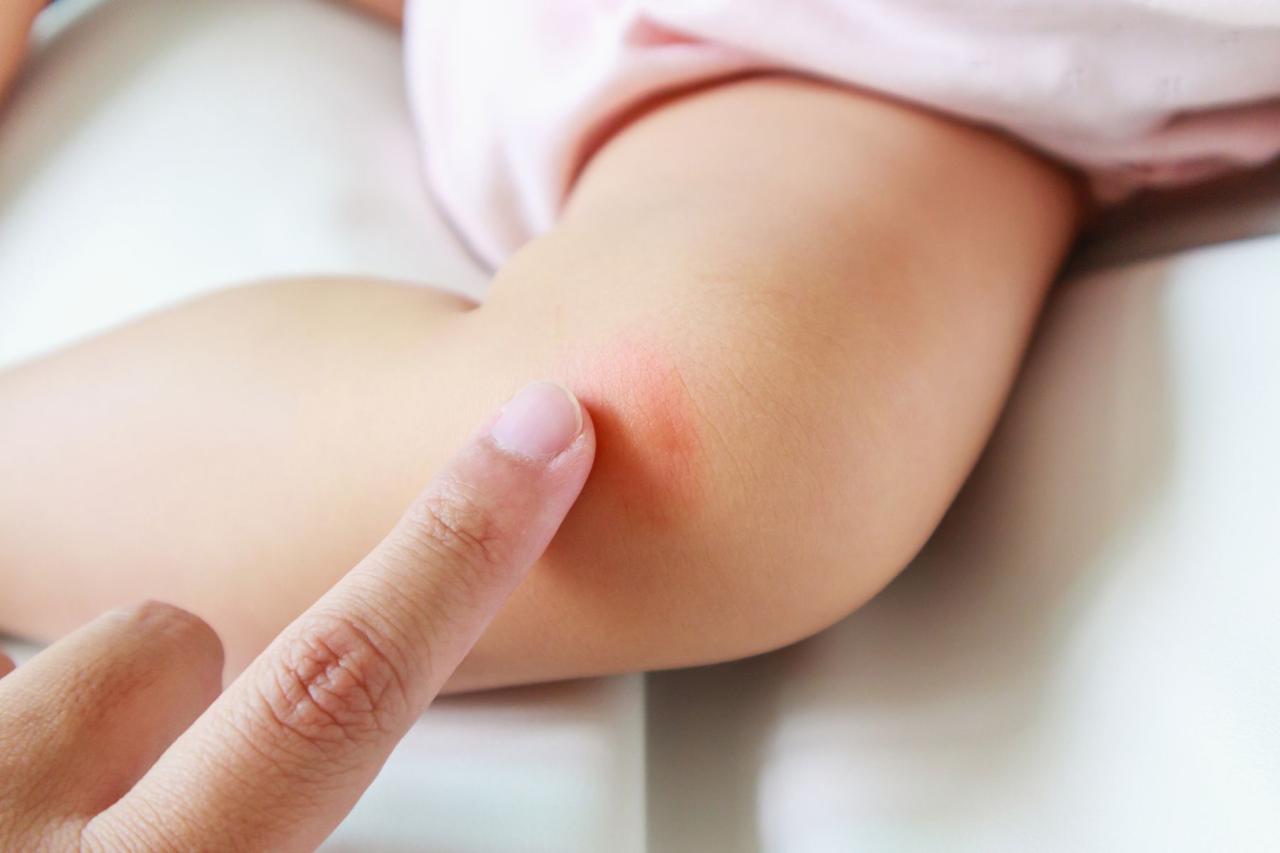 Child skin allergy treatment must be greatly considered