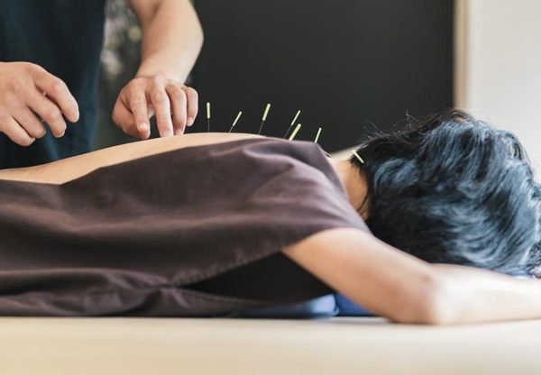 Super Smooth Acupuncture And Dry Needles For Needling Treatment