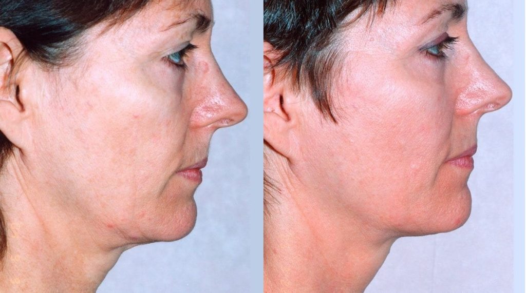 The Best Skin Tightening Treatments of 2022 And What They Do