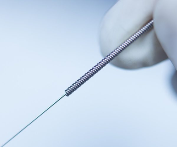 3 Things to Expect After a Dry Needling Treatment