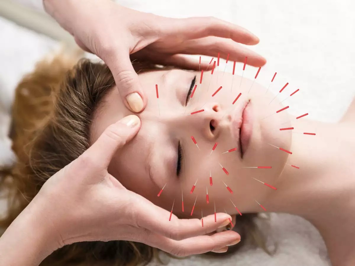 Things to know about the acupuncture therapy