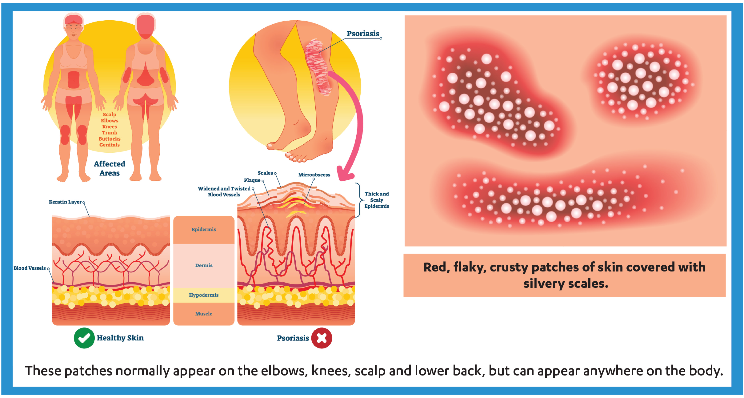 6 Tips for Managing a Psoriasis Flare-ups