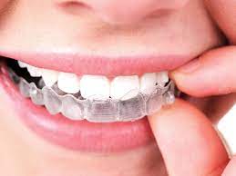 List of Benefits You Get From Invisalign Braces