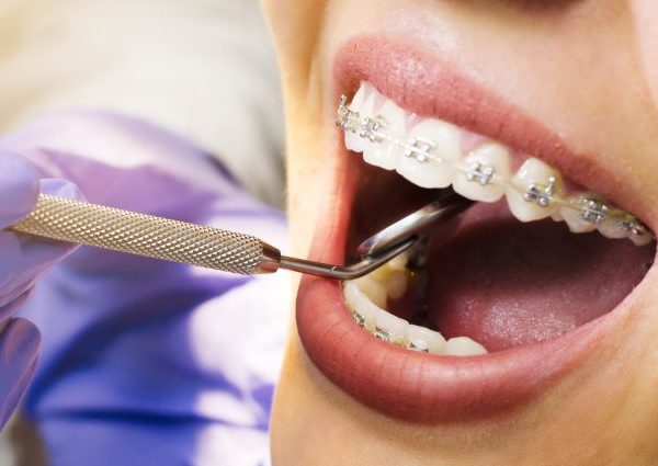 5 Reasons Why You Need Orthodontic Treatment