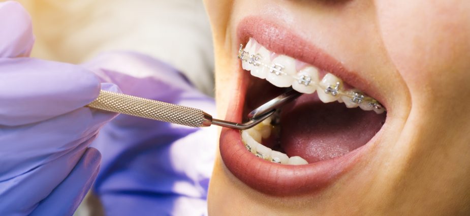 Why Orthodontic Care Is Worth Considering