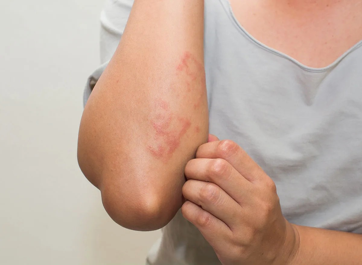 Do I detect a rash there? You may have celiac disease