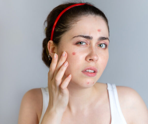 Ways of Treating Acne