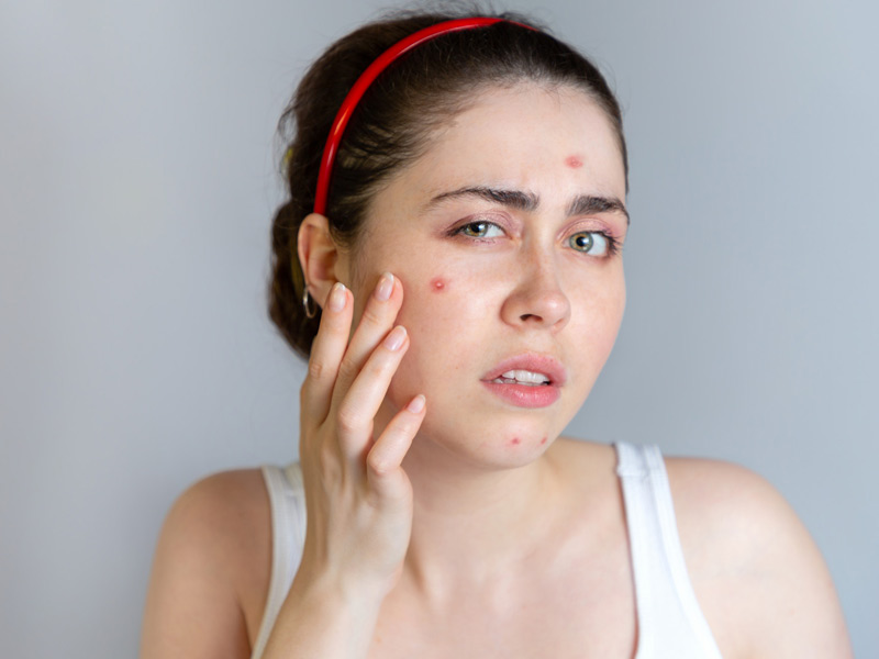 Ways of Treating Acne