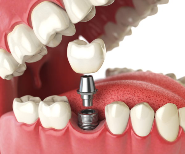 Missing Teeth: Why You Need Dental Implants