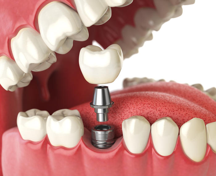 Why Dental Implants Are Key for Missing Teeth
