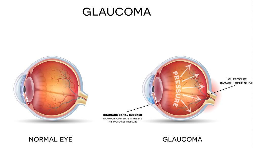 Strategies That Will Help You Prevent Glaucoma