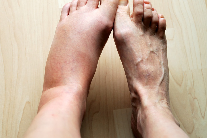 7 Home Remedies for Swollen Legs