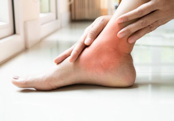 How to Deal with Ankle Discoloration