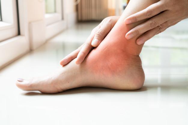 How to Deal with Ankle Discoloration