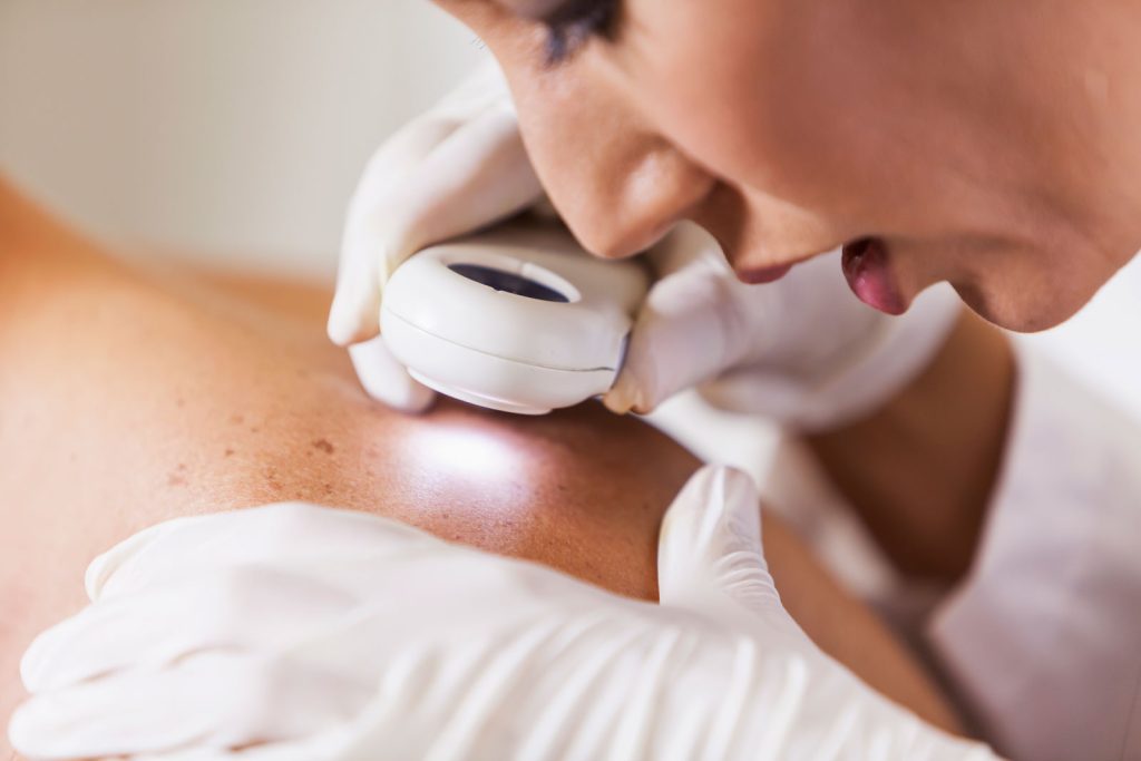 6 Signs That You Should Seek Dermatologic Care for Mole