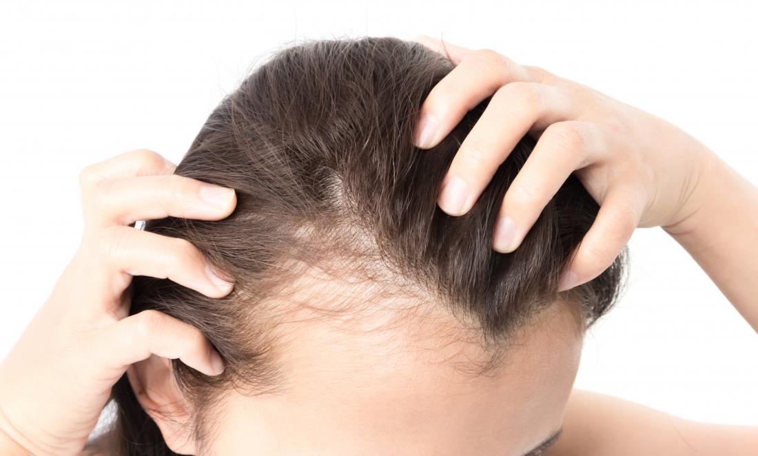 Ways to Treat Hair Loss