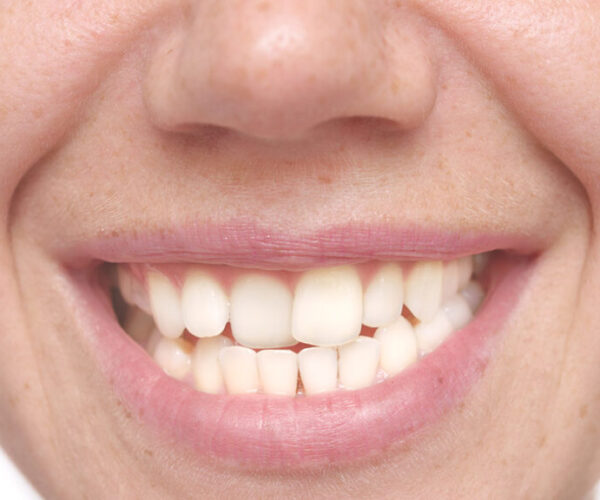Misaligned Teeth- Causes and Treatment