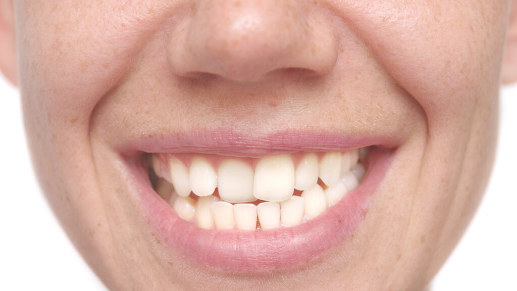 Causes and Solutions for Crooked or Misaligned Teeth