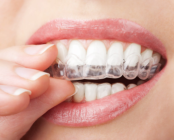 Why You Should Consider Invisalign Aligners