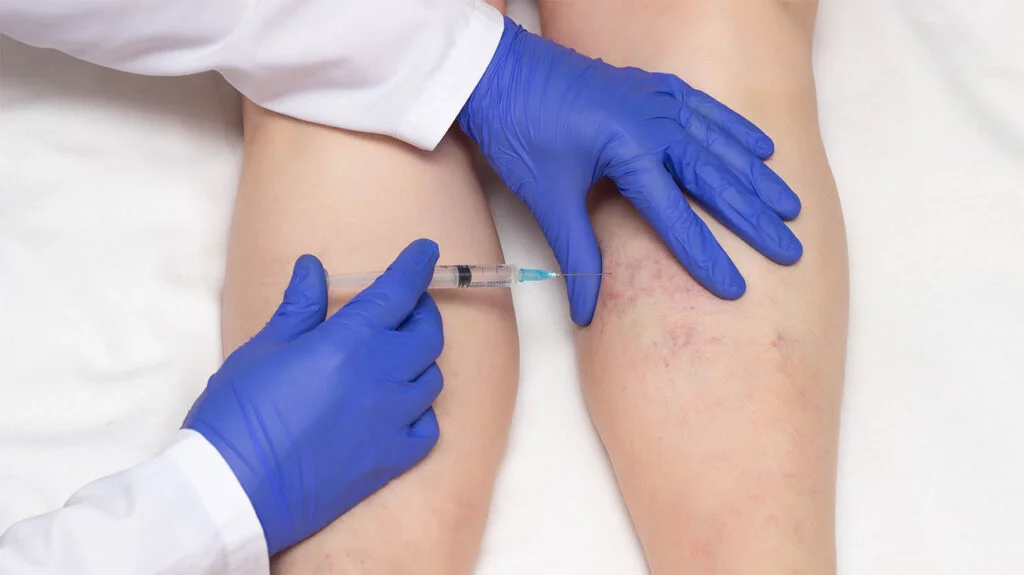 Is Spider Vein Sclerotherapy Treatment Permanent? 