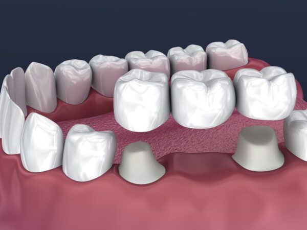 How Similar Are Dental Crowns To Natural Teeth?
