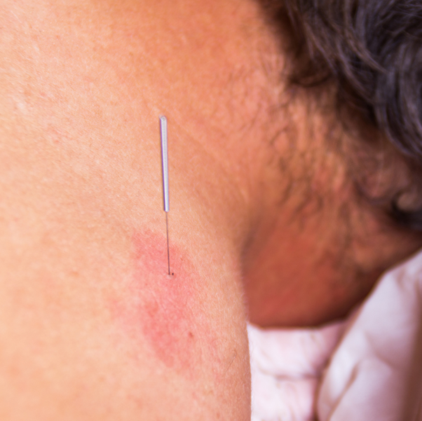 acupuncture Singapore