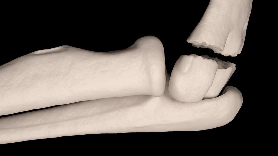 Five Types of Fractures You Should Know