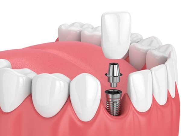 Why Are Dental Implants a Great Choice for Missing Teeth?