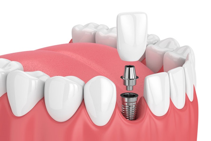 Why Are Dental Implants a Great Choice for Missing Teeth?