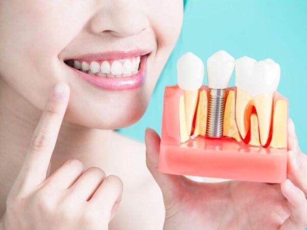 What Benefits Do You Enjoy From Ultratooth Dental Implants?