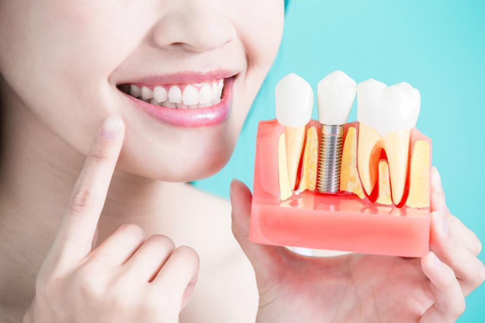 What Makes Ultratooth Dental Implants Unique?