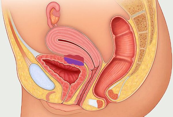 When is it Time To Seek Endometriosis Treatments?