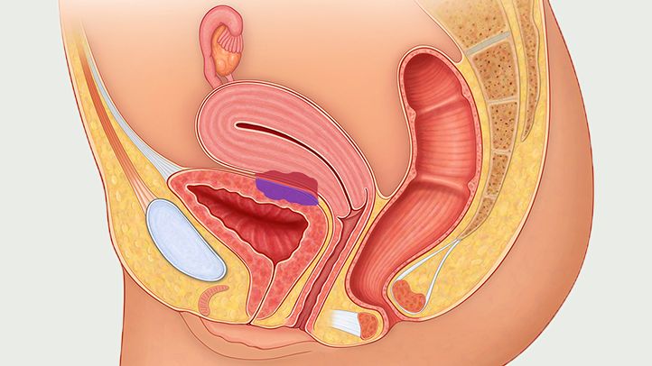 When is it Time To Seek Endometriosis Treatments?