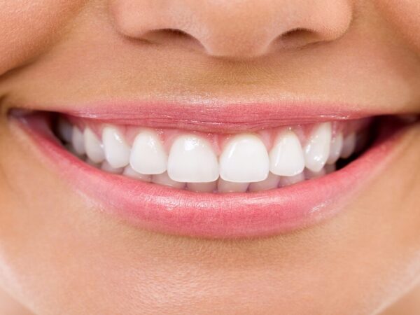 Straightforward Preparation Tips for Getting Dental Veneers