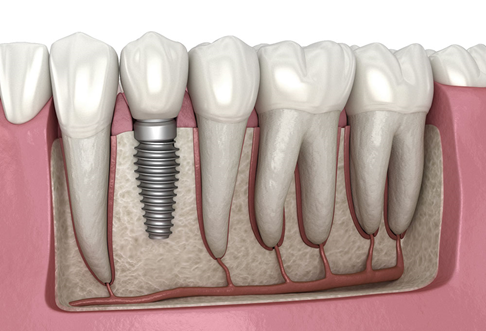 Dental Implant and the Tooth Loss Consequences