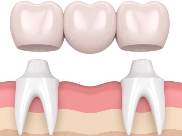 Exploring the Different Kinds of Dental Bridges in North Carolina