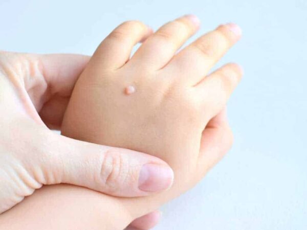 Causes, Risk Factors, and Types of Warts