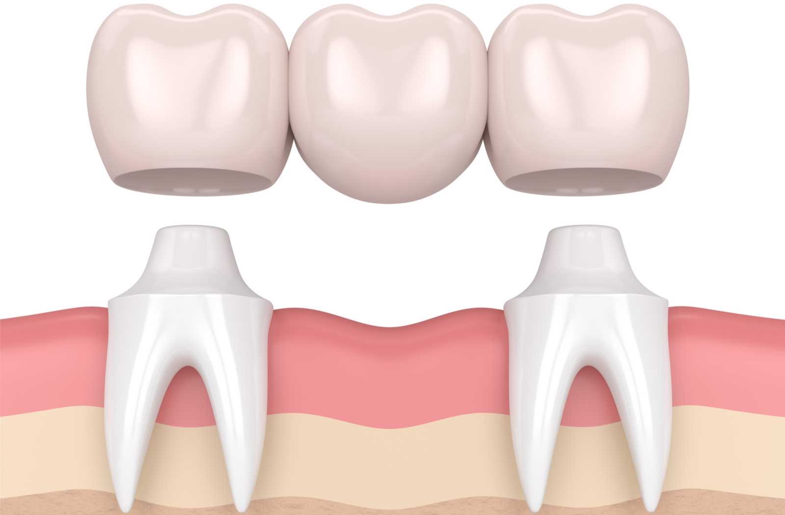 Types of Dental Bridges in North Carolina