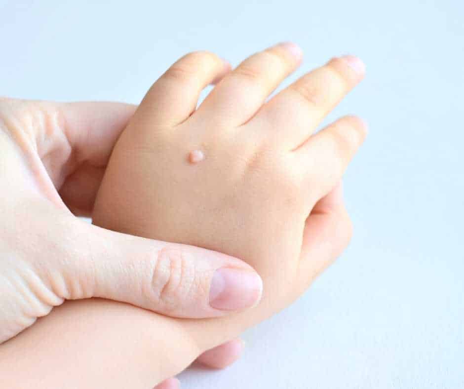 Causes, Risk Factors, and Types of Warts
