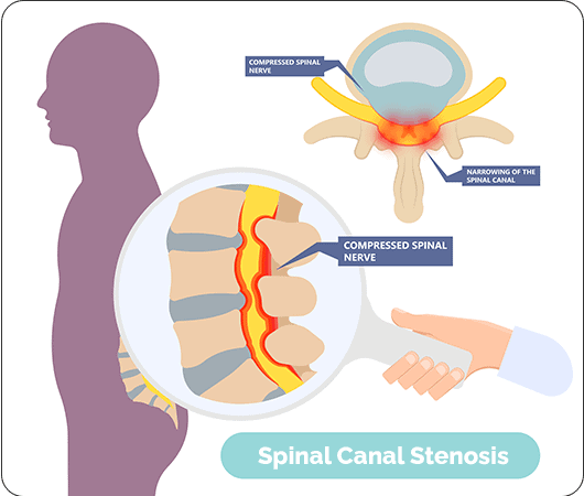 Do Healthy Lifestyle Changes Make A Difference In Spinal Canal Stenosis?