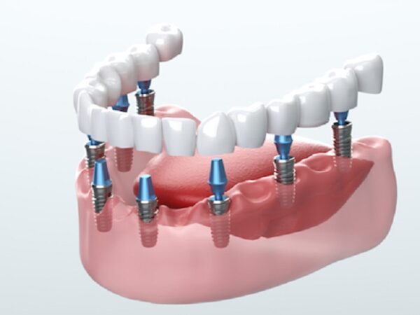 Replacing missing teeth with implants Gordon