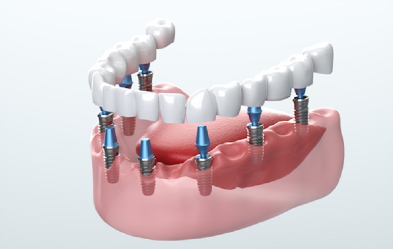 Replacing missing teeth with implants Gordon