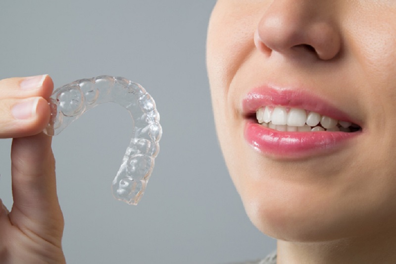 Perfecting your smile with clear aligners: 10 essential points every patient should know