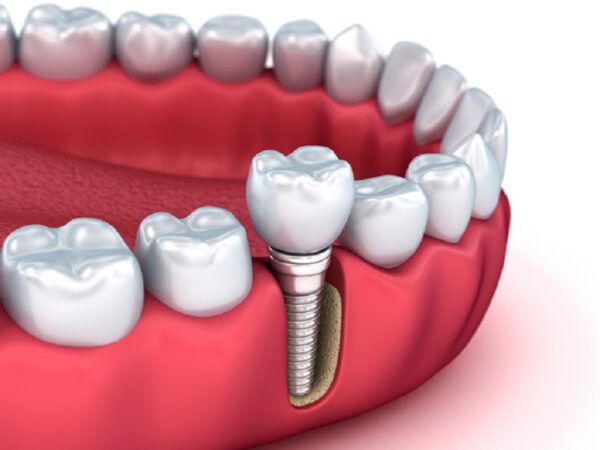 Dentist guide to a brighter smile: little-known facts about dental implants and the role of diet in oral health